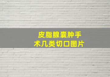 皮脂腺囊肿手术几类切口图片