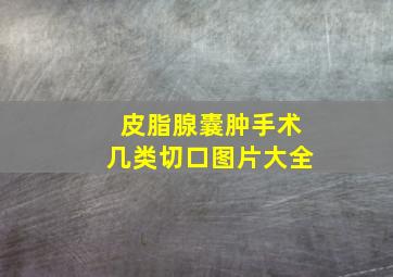 皮脂腺囊肿手术几类切口图片大全