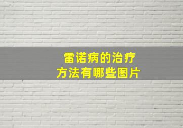 雷诺病的治疗方法有哪些图片